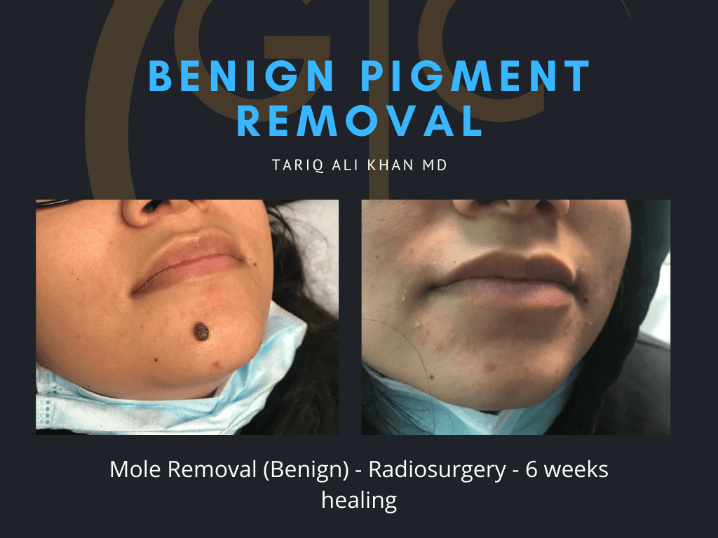 Gentle Care Laser Tustin & Long Beach Before and After picture - Mole Removal